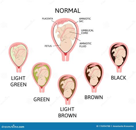 panubigan color|Olygohydramnios: Kaunti Ang Amniotic Fluid Sa Panubigan Ng .